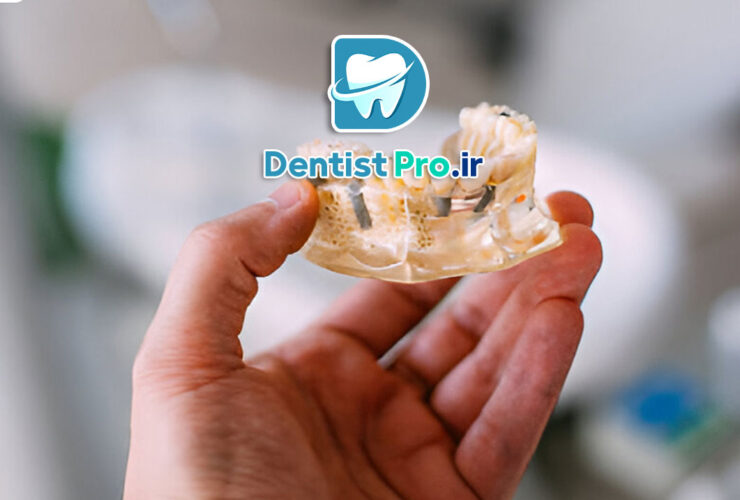 ایمپلنت با روکش زیست سازگار سرامیکی: ترکیب زیبایی و سلامت در دندانپزشکی مدرن