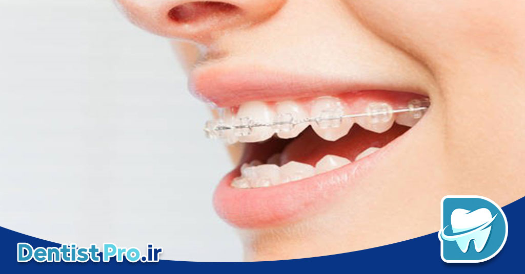 ارتودنسی نامرئی با الگوریتم های تحلیل حرکت دندان: آینده درمانهای ارتودنسی 26 ارتودنسی نامرئی با الگوریتم های تحلیل حرکت دندان: آینده درمانهای ارتودنسی