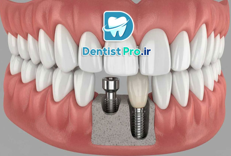 بازسازی بافت نرم فک با فاکتورهای رشد زیستی