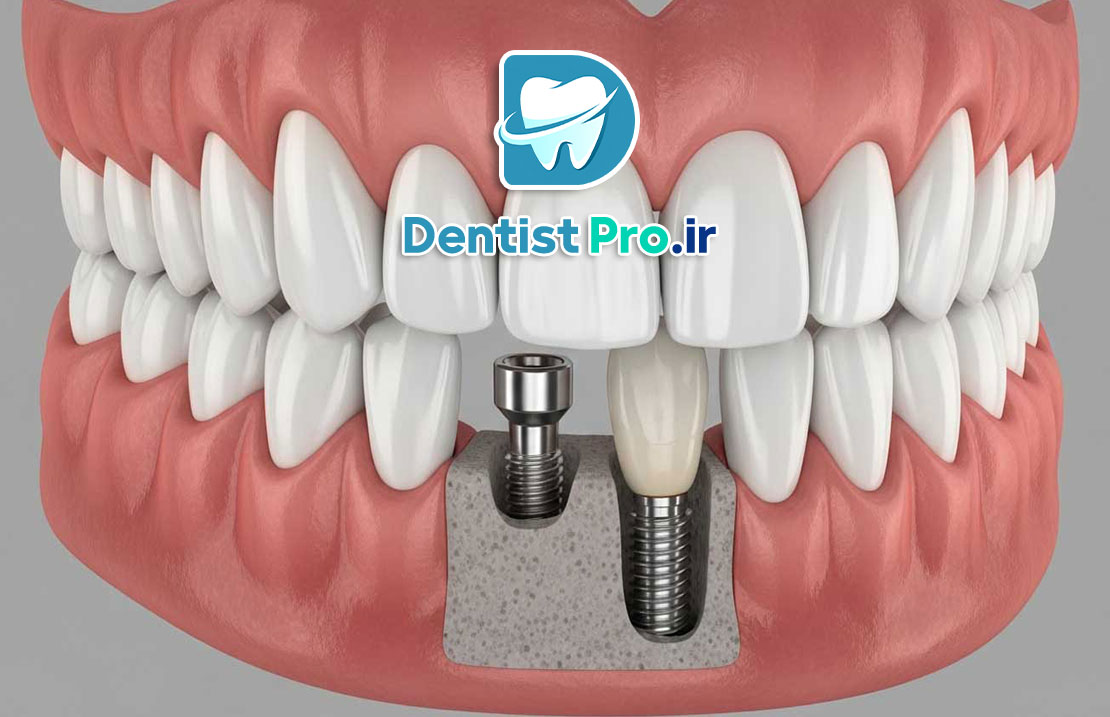 بازسازی بافت نرم فک با فاکتورهای رشد زیستی 25 بازسازی بافت نرم فک با فاکتورهای رشد زیستی
