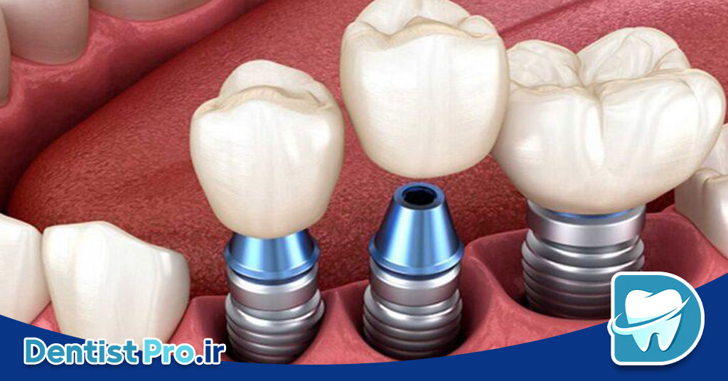 بازسازی بافت نرم فک با فاکتورهای رشد زیستی 26 بازسازی بافت نرم فک با فاکتورهای رشد زیستی