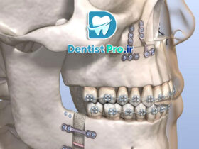 جراحی فک به روش لاپاروسکوپی با رباتیک: انقلاب در جراحی‌های دهان و فک