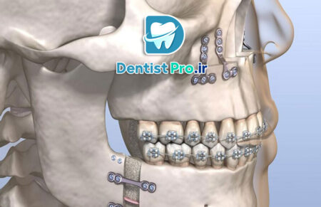 جراحی فک به روش لاپاروسکوپی با رباتیک: انقلاب در جراحی‌های دهان و فک