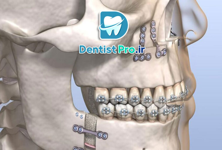 جراحی فک به روش لاپاروسکوپی با رباتیک: انقلاب در جراحی‌های دهان و فک