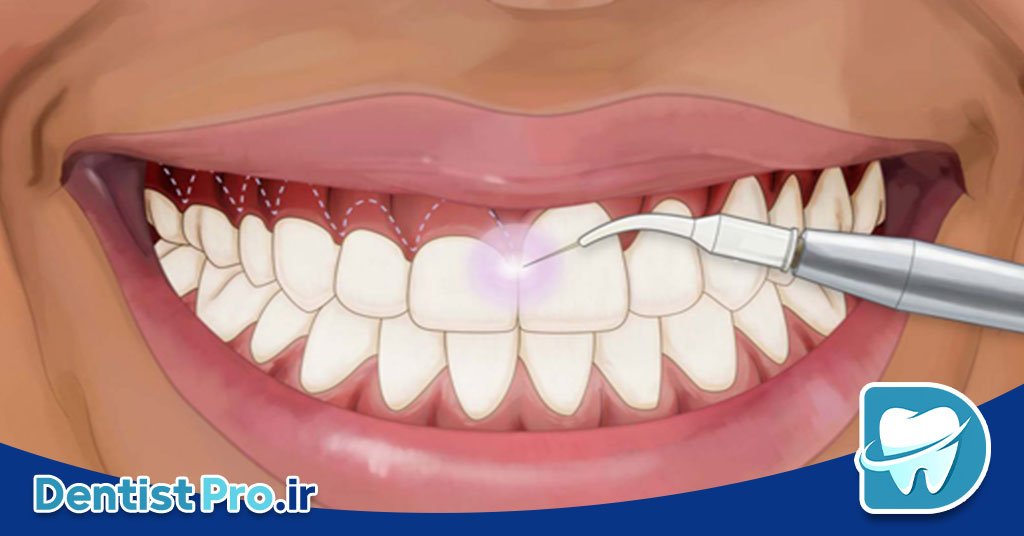 لیزر درمانی لثه ترمیمی: روش نوین و موثر برای سلامت لثه و درمان بیماری‌های پریودنتال