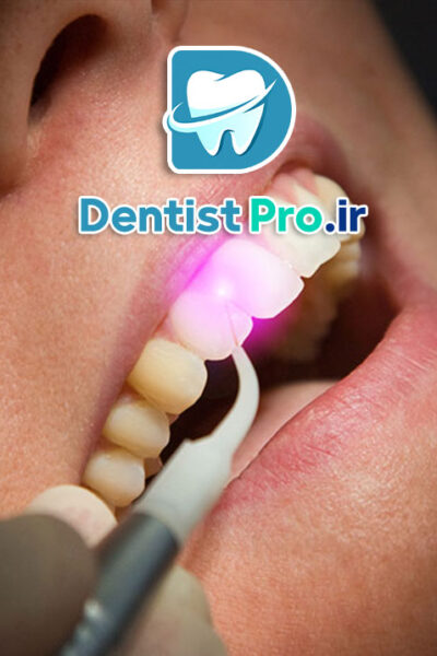 لیزر درمانی لثه ترمیمی: روش نوین و موثر برای سلامت لثه و درمان بیماری‌های پریودنتال