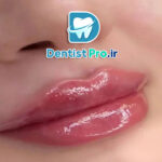 تزریق فیلر لب برای هماهنگی لبخند: راهکاری موثر برای زیبایی و اعتماد به نفس