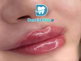 تزریق فیلر لب برای هماهنگی لبخند: راهکاری موثر برای زیبایی و اعتماد به نفس