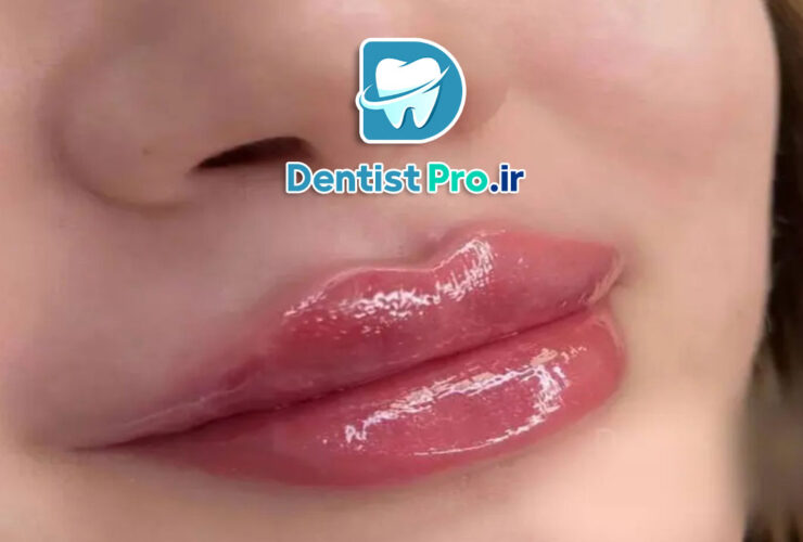 تزریق فیلر لب برای هماهنگی لبخند: راهکاری موثر برای زیبایی و اعتماد به نفس