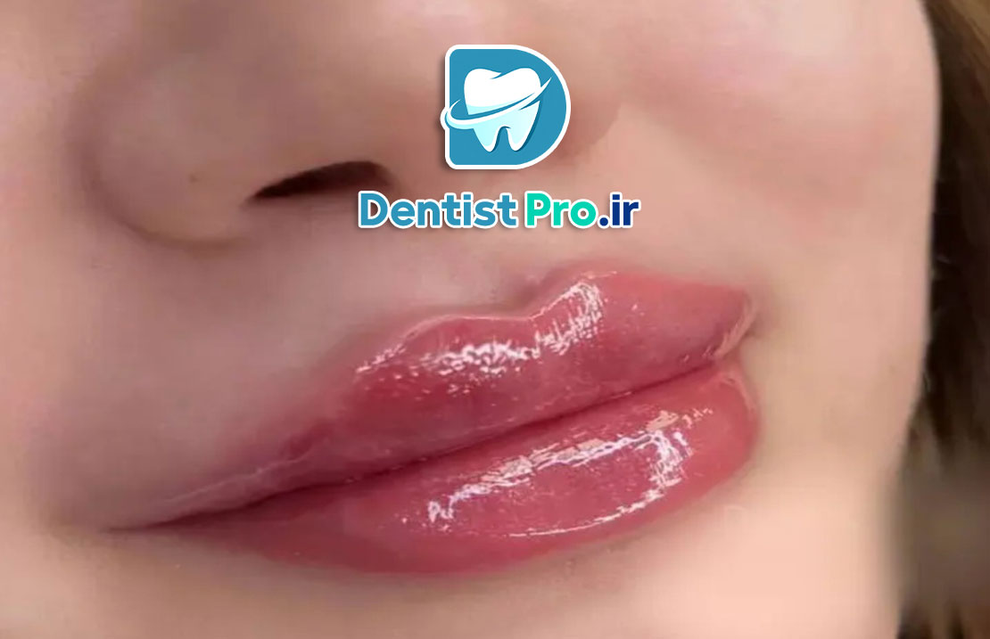 تزریق فیلر لب برای هماهنگی لبخند: راهکاری موثر برای زیبایی و اعتماد به نفس 25 تزریق فیلر لب برای هماهنگی لبخند: راهکاری موثر برای زیبایی و اعتماد به نفس