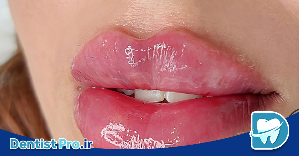 تزریق فیلر لب برای هماهنگی لبخند: راهکاری موثر برای زیبایی و اعتماد به نفس 26 تزریق فیلر لب برای هماهنگی لبخند: راهکاری موثر برای زیبایی و اعتماد به نفس