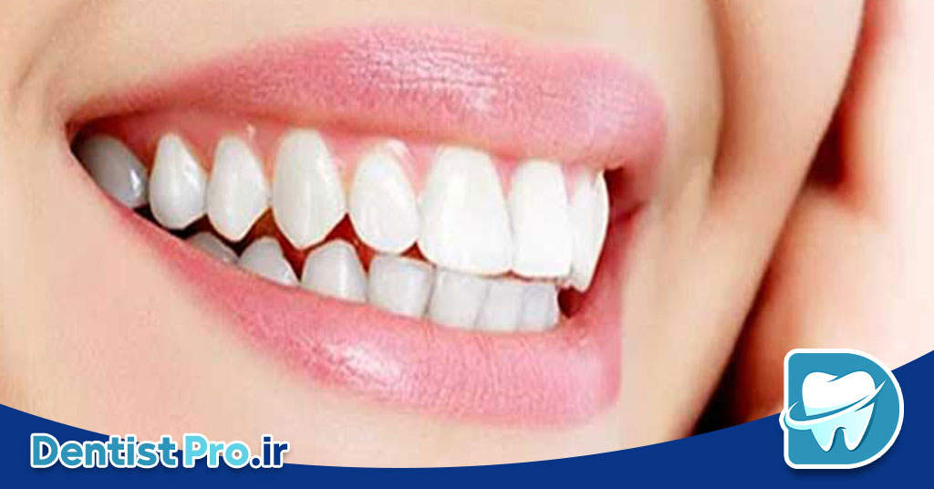 ونیر سرامیکی لیتیوم دی سیلیکات: پیشرفته‌ترین راهکار زیبایی دندان