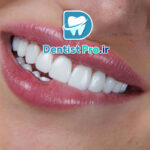 ونیر سرامیکی لیتیوم دی سیلیکات: پیشرفته‌ترین راهکار زیبایی دندان