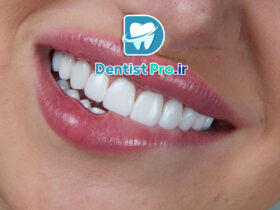 ونیر سرامیکی لیتیوم دی سیلیکات: پیشرفته‌ترین راهکار زیبایی دندان
