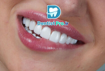 ونیر سرامیکی لیتیوم دی سیلیکات: پیشرفته‌ترین راهکار زیبایی دندان