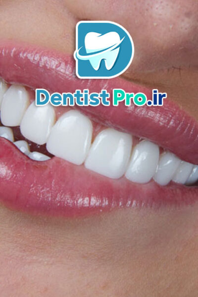ونیر سرامیکی لیتیوم دی سیلیکات: پیشرفته‌ترین راهکار زیبایی دندان