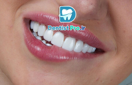 ونیر سرامیکی لیتیوم دی سیلیکات: پیشرفته‌ترین راهکار زیبایی دندان