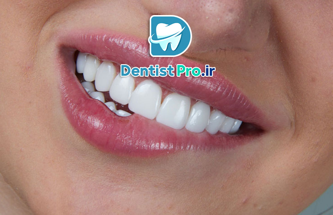ونیر سرامیکی لیتیوم دی سیلیکات: پیشرفته‌ترین راهکار زیبایی دندان