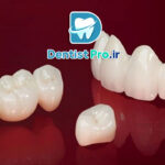 کامپوزیت میکروفیلر نانوکامپوزیت: پیشرفت نوین در دندانپزشکی ترمیمی