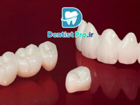 کامپوزیت میکروفیلر نانوکامپوزیت: پیشرفت نوین در دندانپزشکی ترمیمی