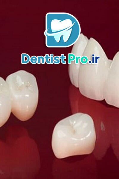 کامپوزیت میکروفیلر نانوکامپوزیت: پیشرفت نوین در دندانپزشکی ترمیمی