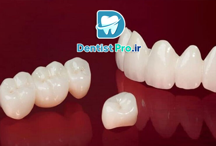 کامپوزیت میکروفیلر نانوکامپوزیت: پیشرفت نوین در دندانپزشکی ترمیمی