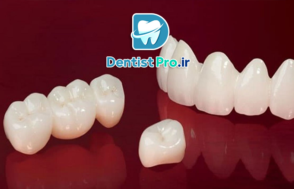 کامپوزیت میکروفیلر نانوکامپوزیت: پیشرفت نوین در دندانپزشکی ترمیمی