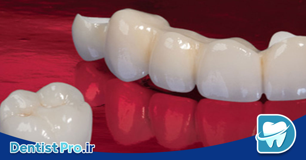 کامپوزیت میکروفیلر نانوکامپوزیت: پیشرفت نوین در دندانپزشکی ترمیمی