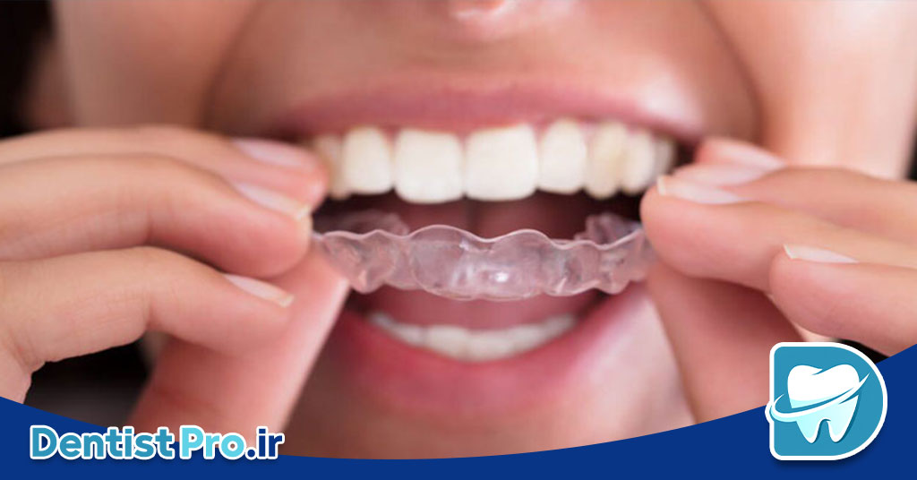 پلاک شبانه محافظ دندان در Bruxism: راهنمای جامع مراقبت و پیشگیری 26 پلاک شبانه محافظ دندان در Bruxism: راهنمای جامع مراقبت و پیشگیری