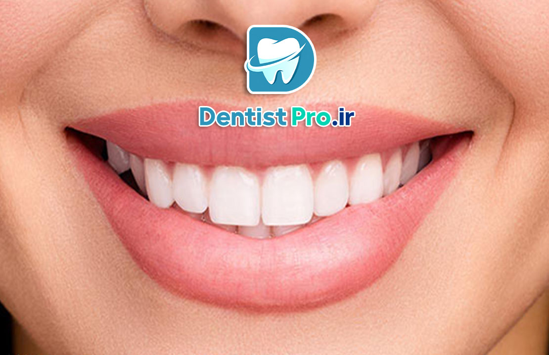 اصلاح غیرجراحی لبخند: راهنمای کامل و تخصصی برای زیبایی طبیعی لبخند شما 25 اصلاح غیرجراحی لبخند: راهنمای کامل و تخصصی برای زیبایی طبیعی لبخند شما