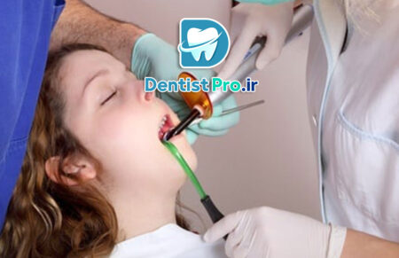 درمان ترمیمی بی درد با سیستم های ایزوژل کودکان: راهکاری نوین برای مراقبت از دندان‌های کودکان