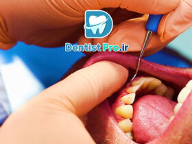 جراحی لثه پلاستیک با هدف زیبایی لبخند