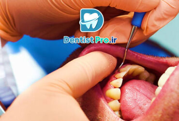 جراحی لثه پلاستیک با هدف زیبایی لبخند