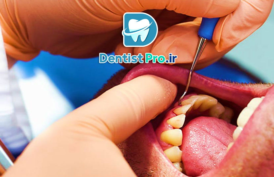 جراحی لثه پلاستیک با هدف زیبایی لبخند 25 جراحی لثه پلاستیک با هدف زیبایی لبخند