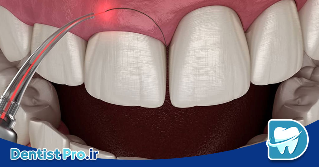 جراحی لثه پلاستیک با هدف زیبایی لبخند 26 جراحی لثه پلاستیک با هدف زیبایی لبخند