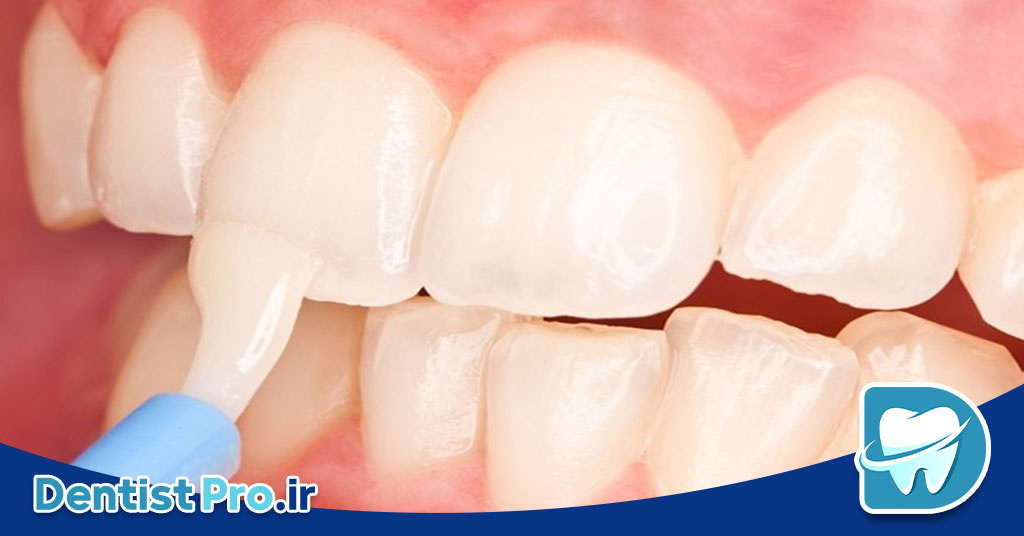 فلوراید تراپی پیشگیرانه: کلید سلامت دندان‌ها