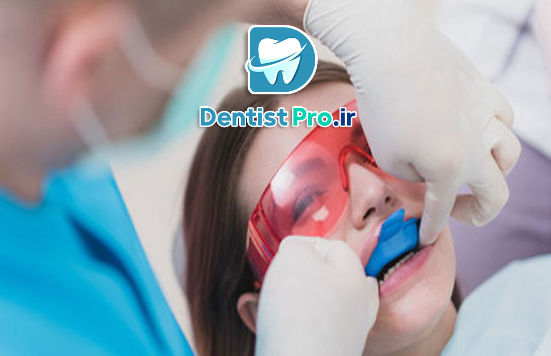 فلوراید تراپی پیشگیرانه: کلید سلامت دندان‌ها