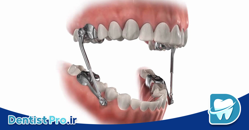 همه چیز در مورد ارتودنسی پیشگیرانه فانکشنال در سنین رشد 26 همه چیز در مورد ارتودنسی پیشگیرانه فانکشنال در سنین رشد