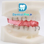 همه چیز در مورد ارتودنسی پیشگیرانه فانکشنال در سنین رشد