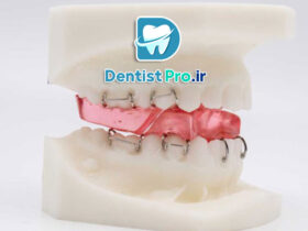 همه چیز در مورد ارتودنسی پیشگیرانه فانکشنال در سنین رشد