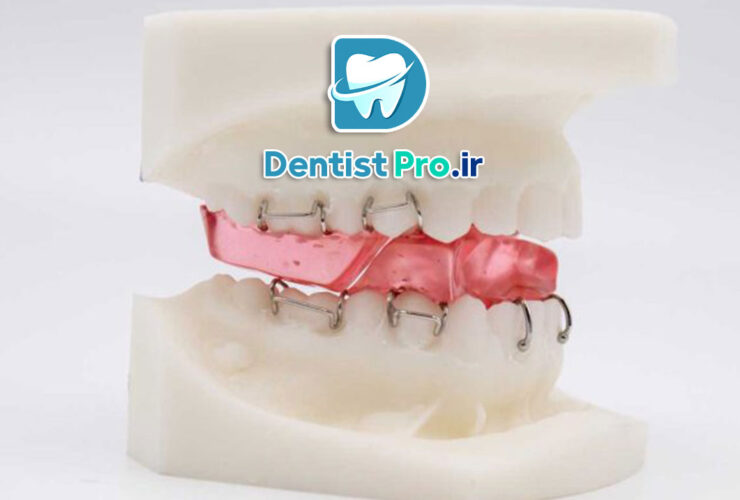 همه چیز در مورد ارتودنسی پیشگیرانه فانکشنال در سنین رشد