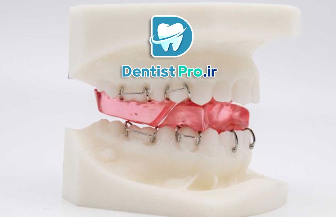 همه چیز در مورد ارتودنسی پیشگیرانه فانکشنال در سنین رشد 25 همه چیز در مورد ارتودنسی پیشگیرانه فانکشنال در سنین رشد