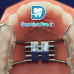 ارتودنسی پیشگیری در کودکان: کلیدی برای سلامت دهان و دندان در آینده