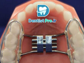 ارتودنسی پیشگیری در کودکان: کلیدی برای سلامت دهان و دندان در آینده