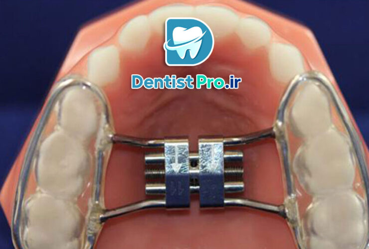 ارتودنسی پیشگیری در کودکان: کلیدی برای سلامت دهان و دندان در آینده