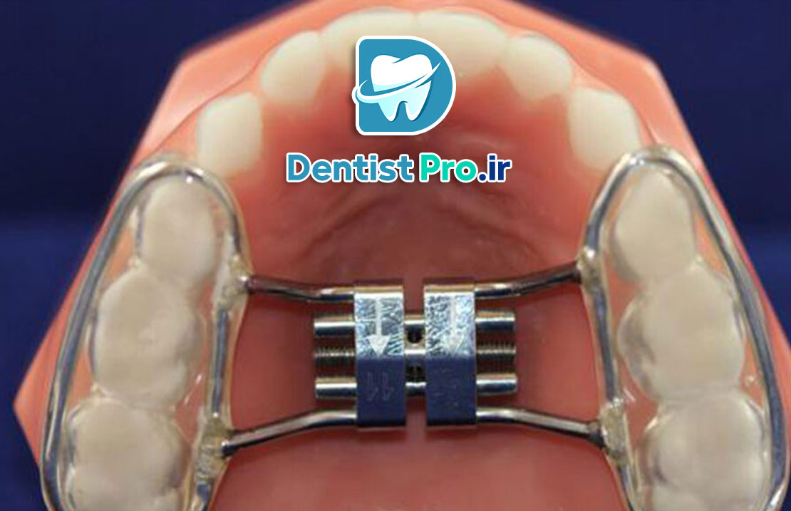 ارتودنسی پیشگیری در کودکان: کلیدی برای سلامت دهان و دندان در آینده