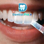 پوشش محافظ مینای دندان: راز حفظ سلامت و زیبایی دندان‌ها