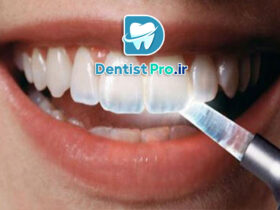 پوشش محافظ مینای دندان: راز حفظ سلامت و زیبایی دندان‌ها