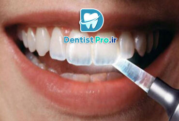 پوشش محافظ مینای دندان: راز حفظ سلامت و زیبایی دندان‌ها