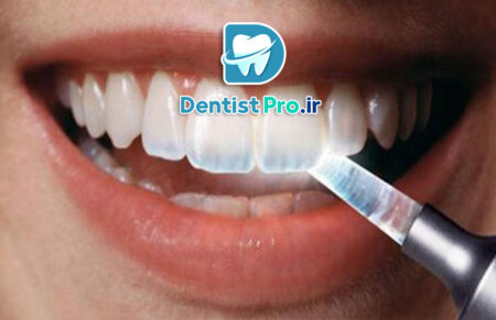 پوشش محافظ مینای دندان: راز حفظ سلامت و زیبایی دندان‌ها